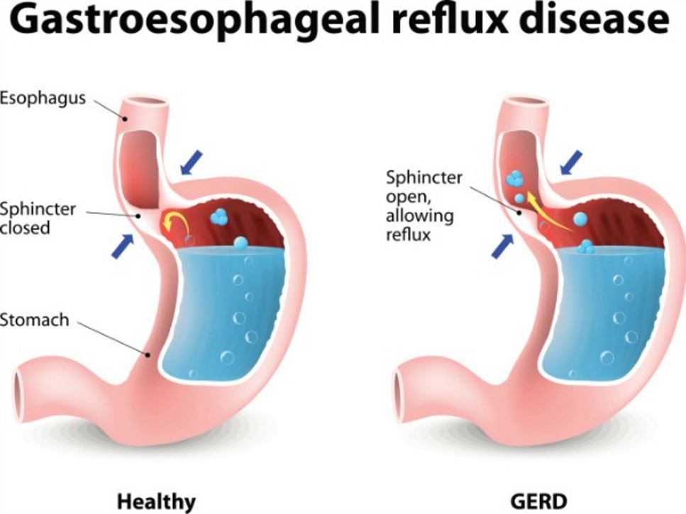 What You Need to Know About GERD